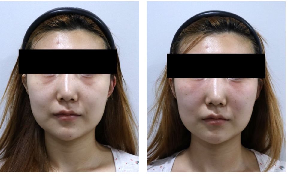 눈밑 쥬베룩 볼륨 시술 전후 비교