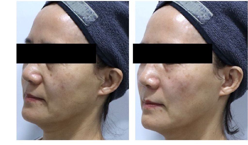 앞광대 래디어스 시술 전후 비교