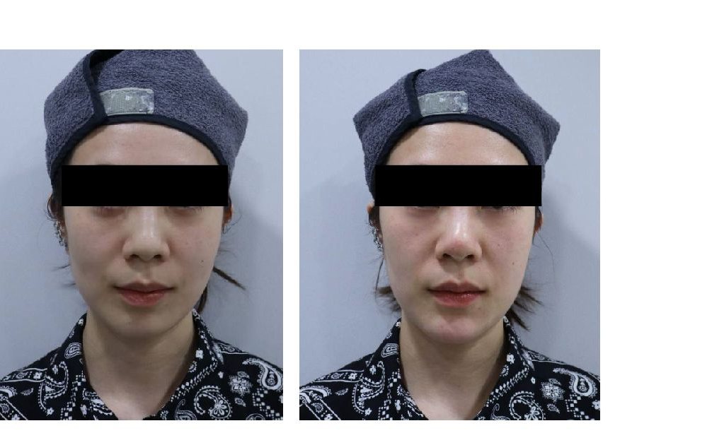 백옥주사 시술 전후 비교