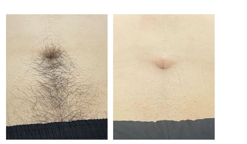 배 제모 시술 전후 비교